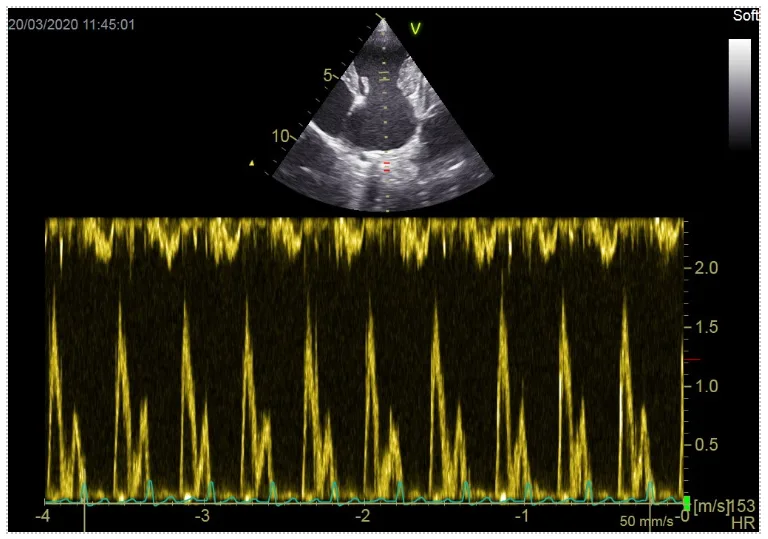 Pulsed wave doppler image at Cheshire Cardiology